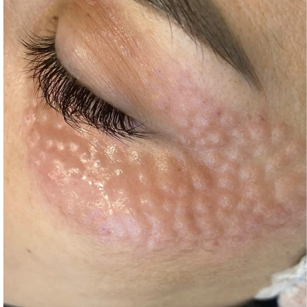 COLLOST® micro 0,05 г для деликатных зон