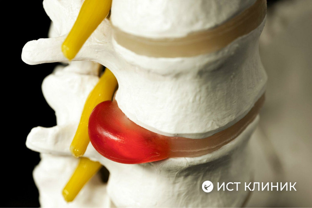 ‼️ГРЫЖА‼️ работа с грыжами, протрузиями и иными дегенеративными.