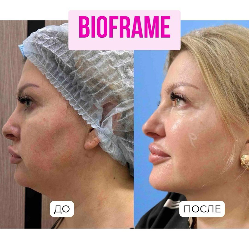 Биоревитализация Bioframe