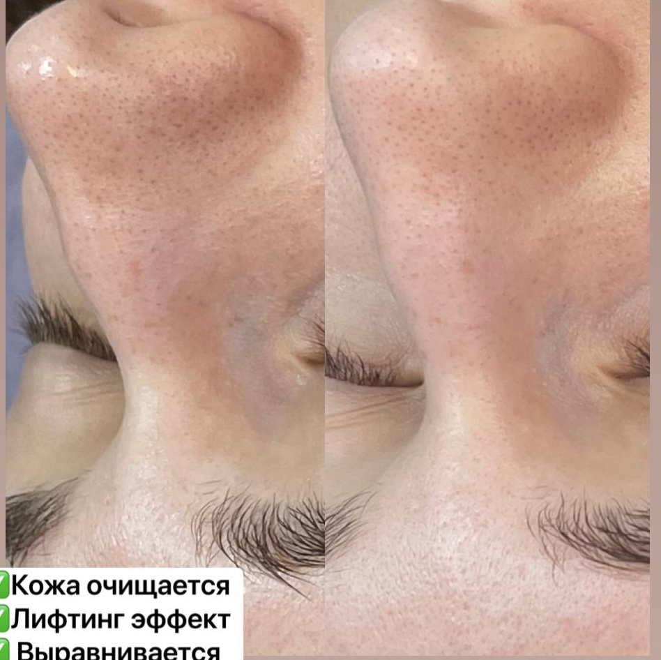 Карбоновый пиллинг