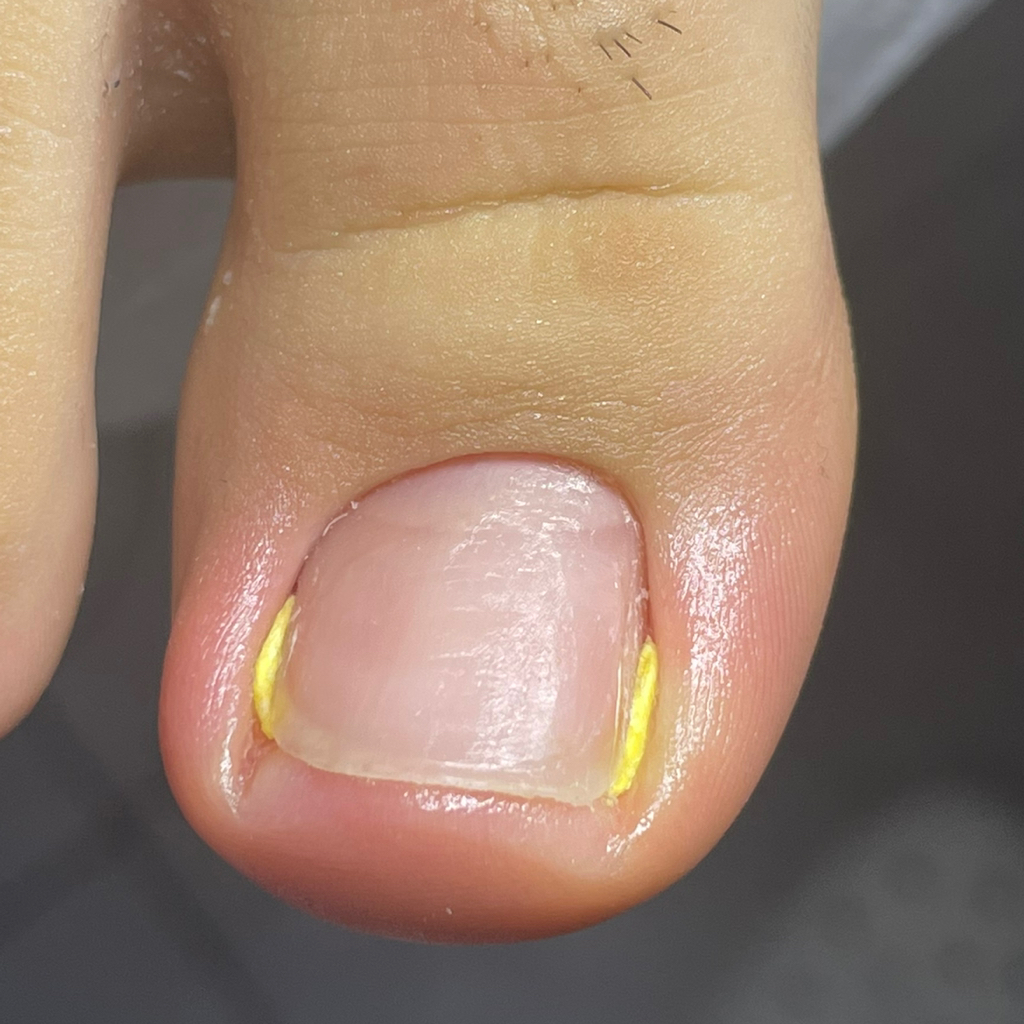 Обработка 1 зоны (ноготь, мозоль и тд.)