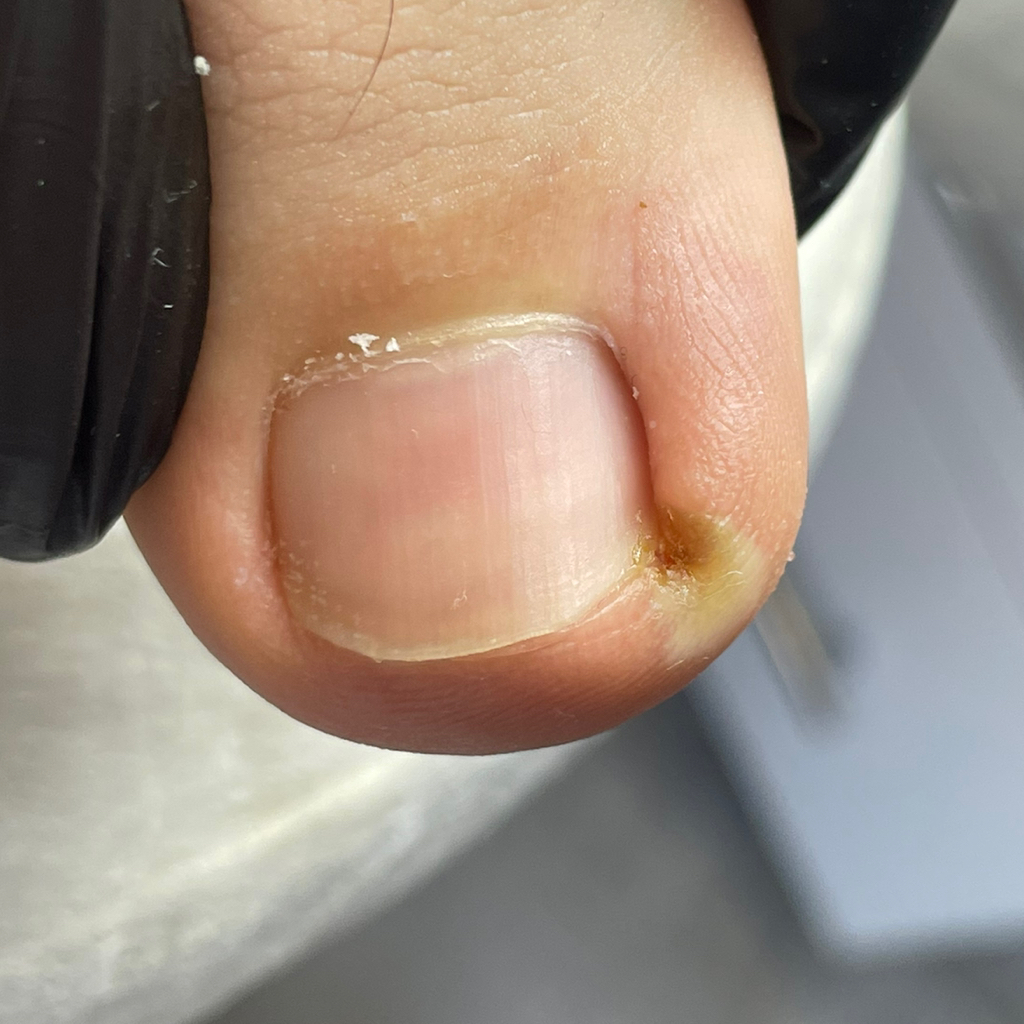 Обработка врастающей части ногтя