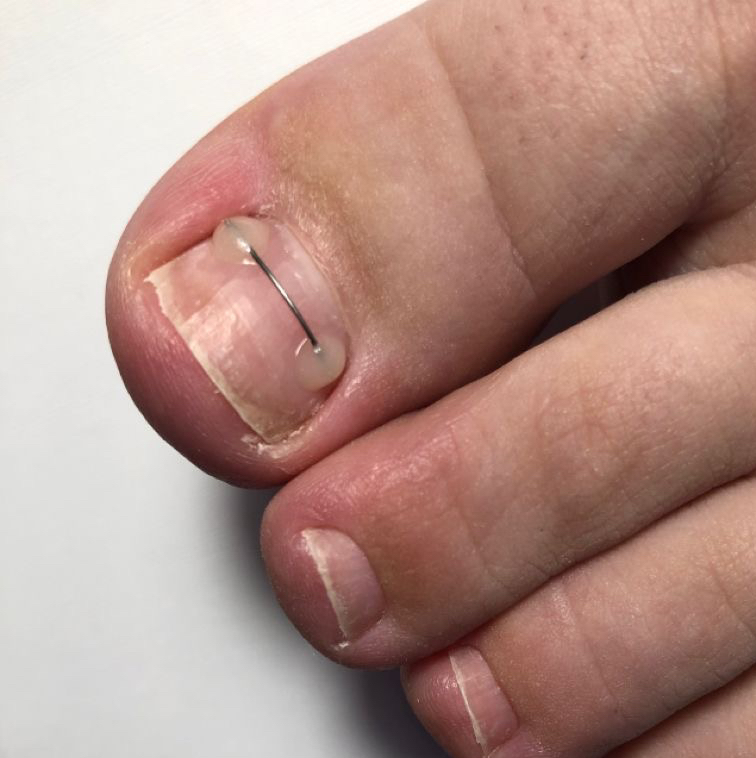 Установка коррекционной системы «Титановая нить»