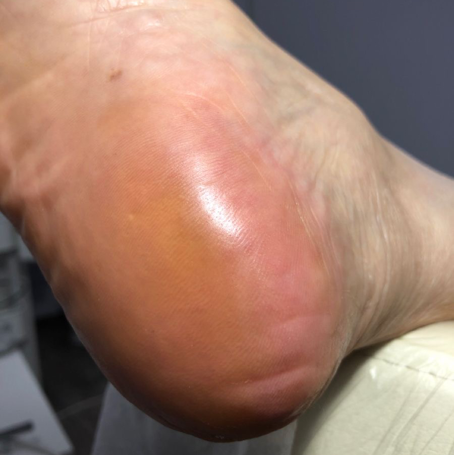 SMART педикюр обработка пяток