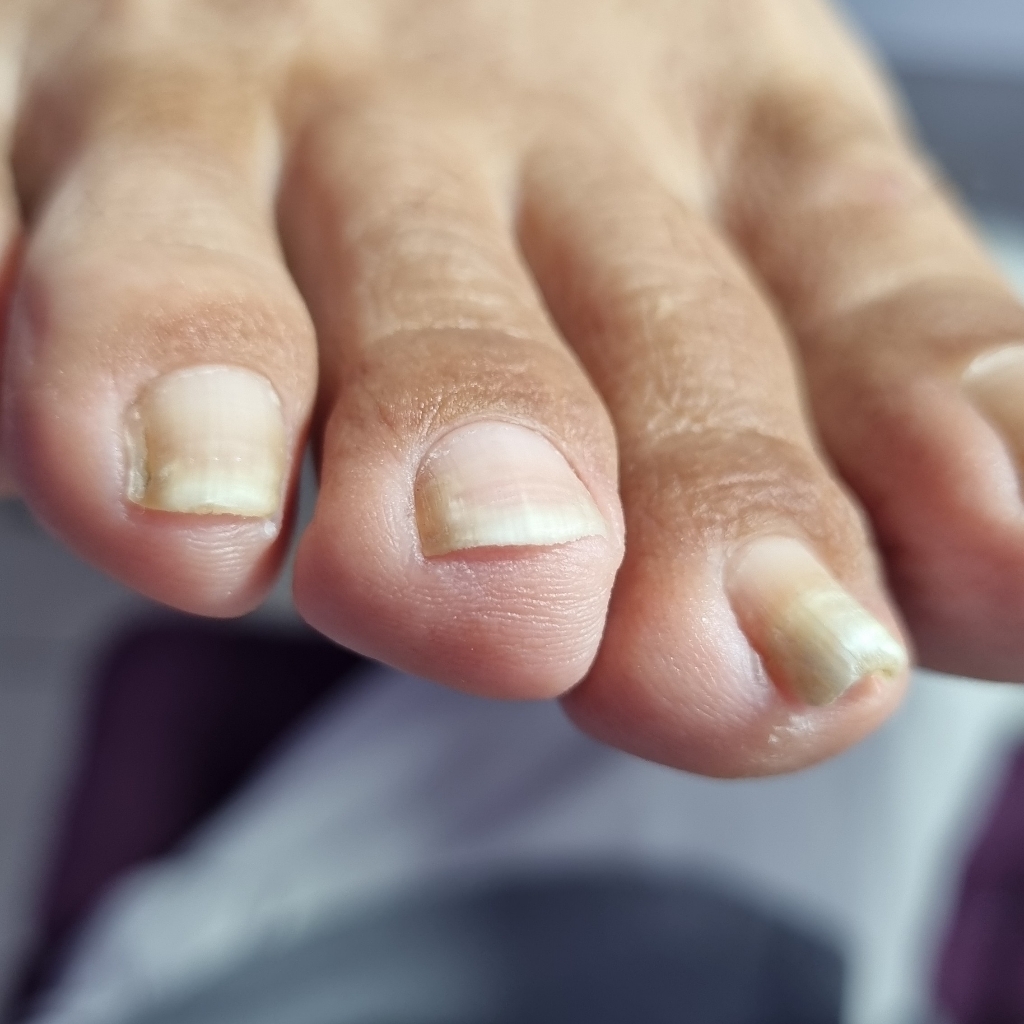 Обработка вростающего ногтя