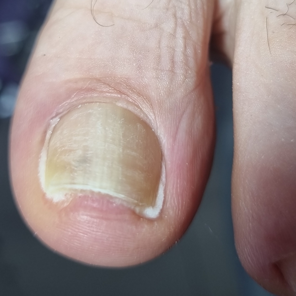 Тампонирование 1 ногтя