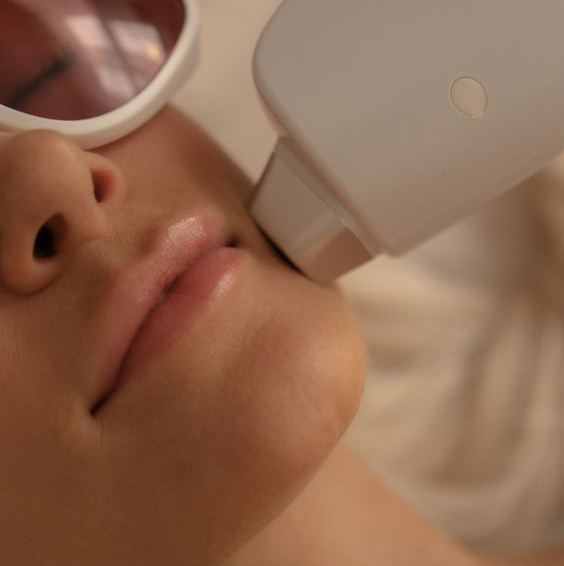 Лазерная эпиляция-Верхняя губа