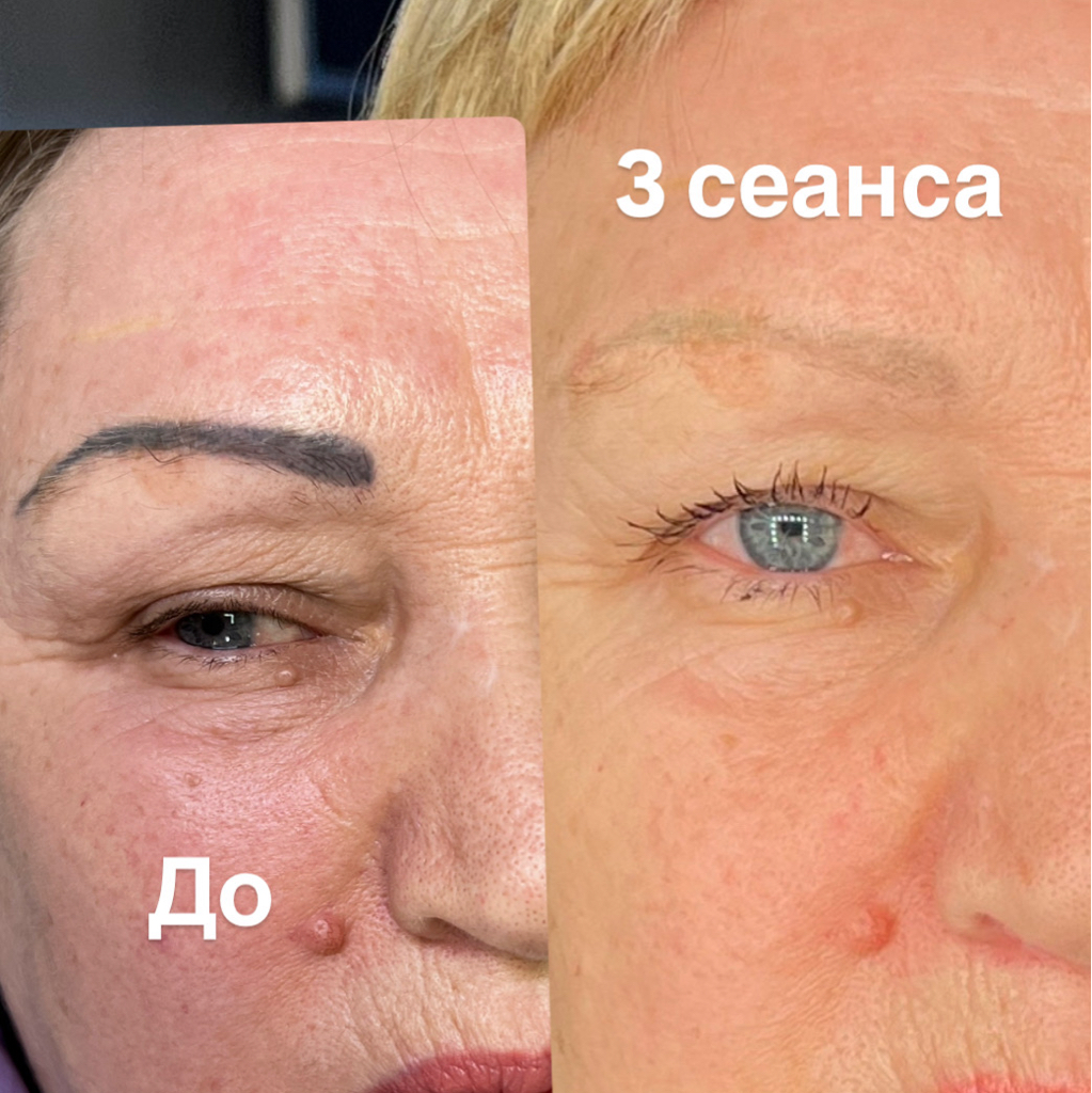 Удаление перманентного макияжа