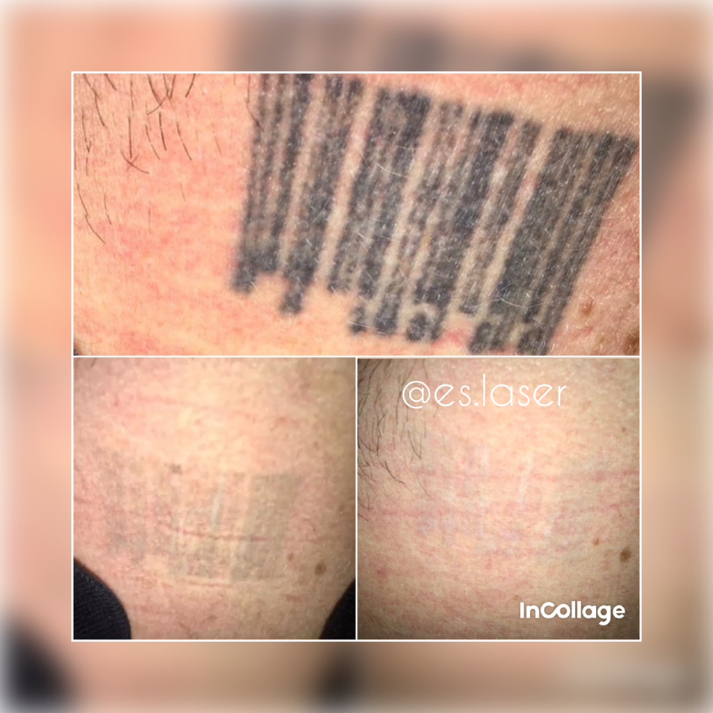 Удаление тату