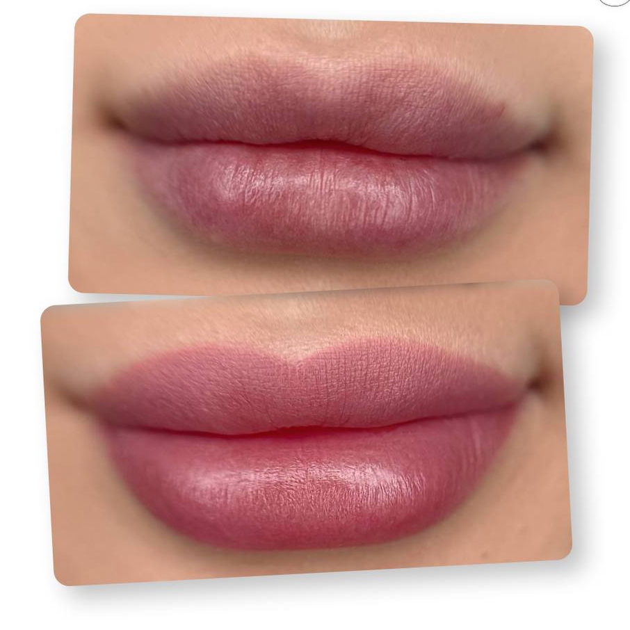 Биоревитализация губ