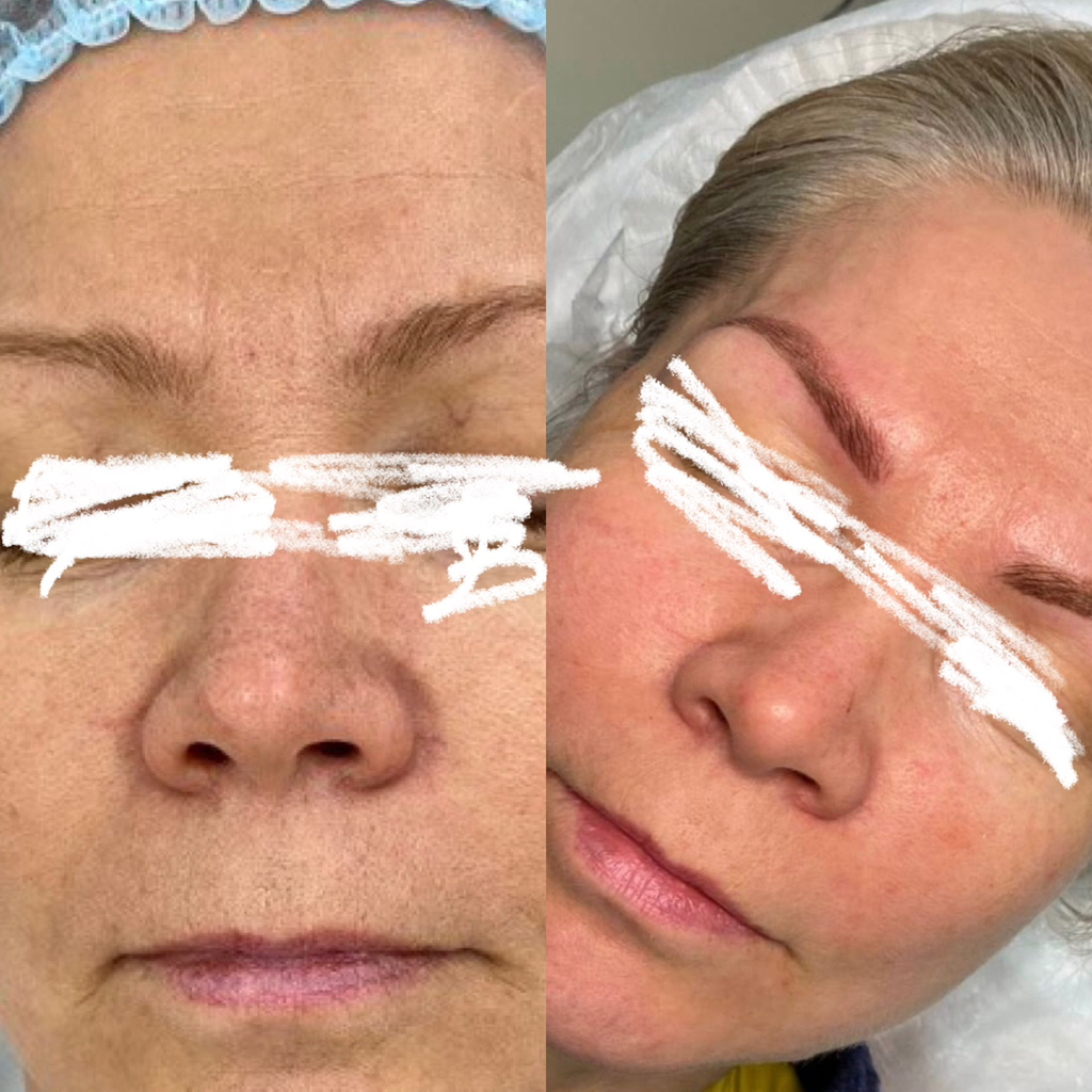 Фракционная мезо