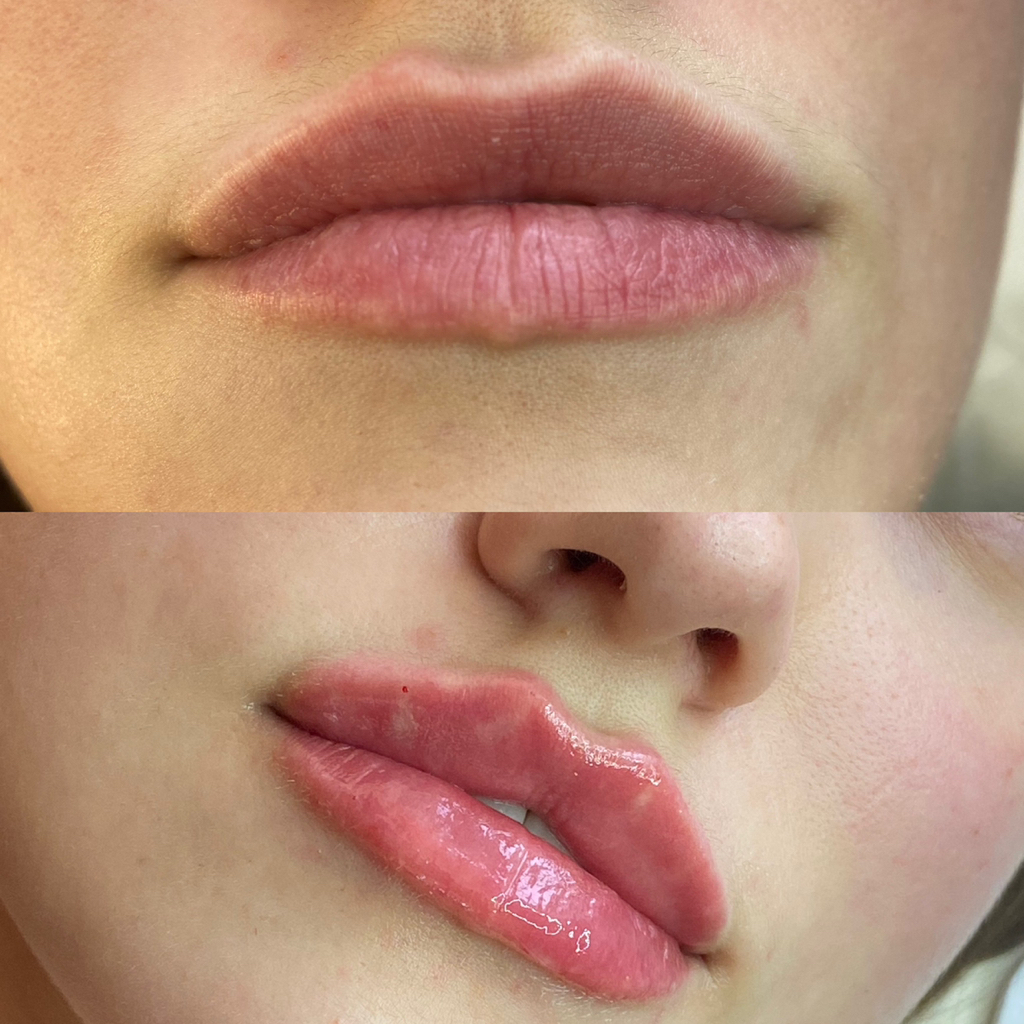 Увеличение губ