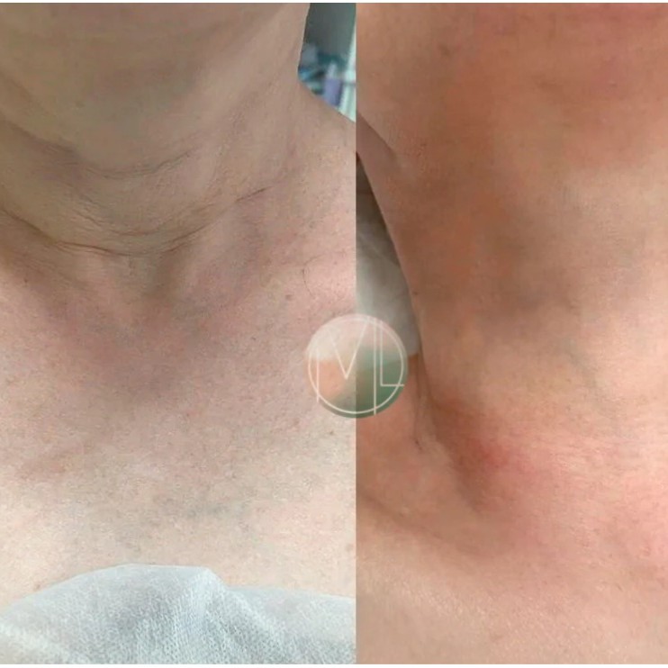 Belotero Soft (БЕЛОТЕРО СОФТ) 1 мл (филлер для контурной пластики)