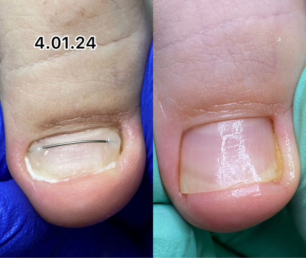 Установка коррекционной  системы,титановая нить