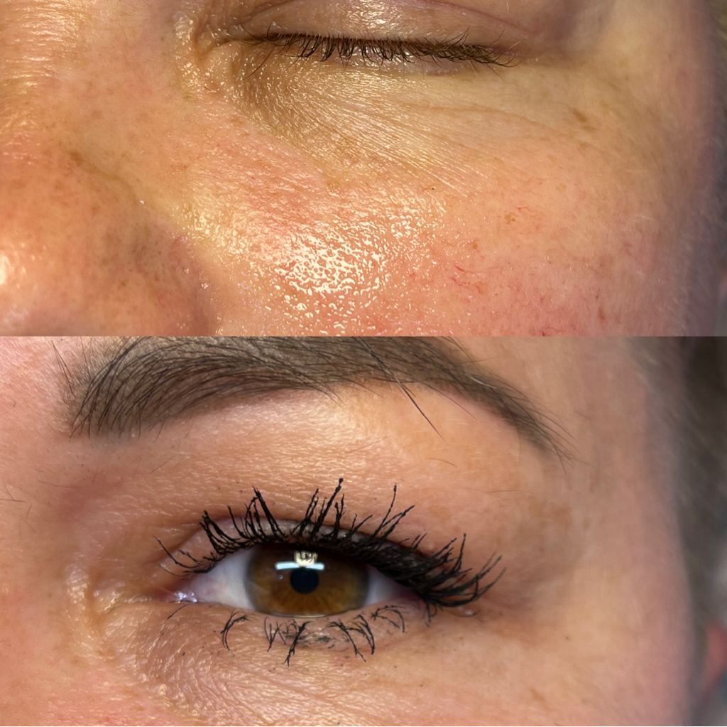 Биоревитализация зоны глаз