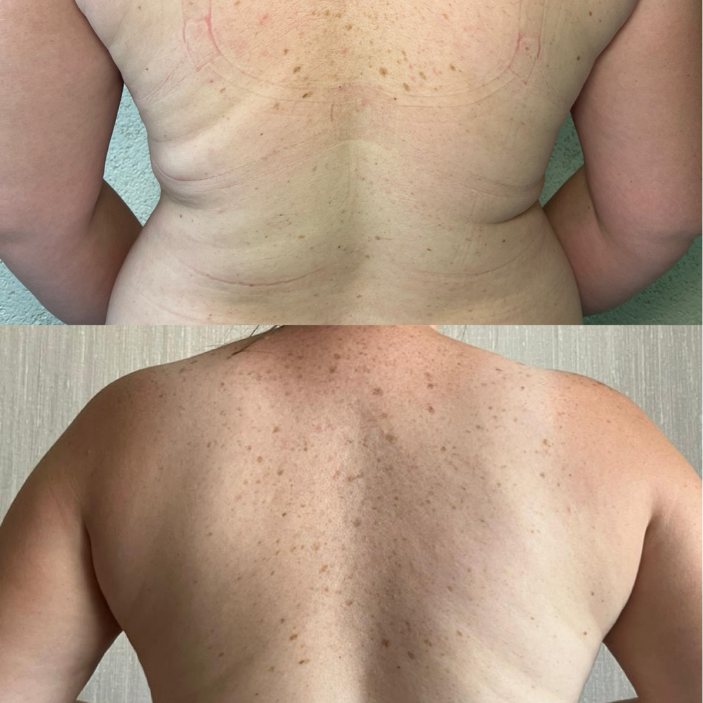 Сосудистый паравертебральный этап