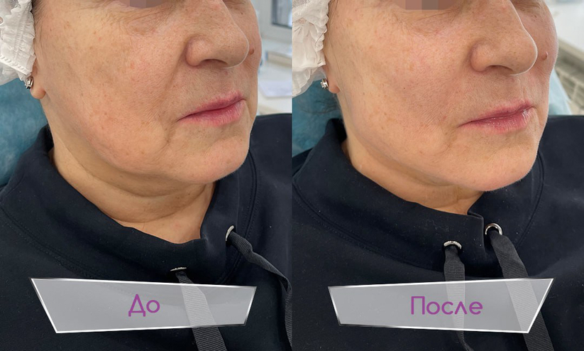 Контурная пластика