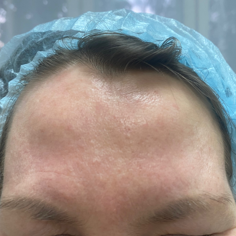 Коррекция ботокса