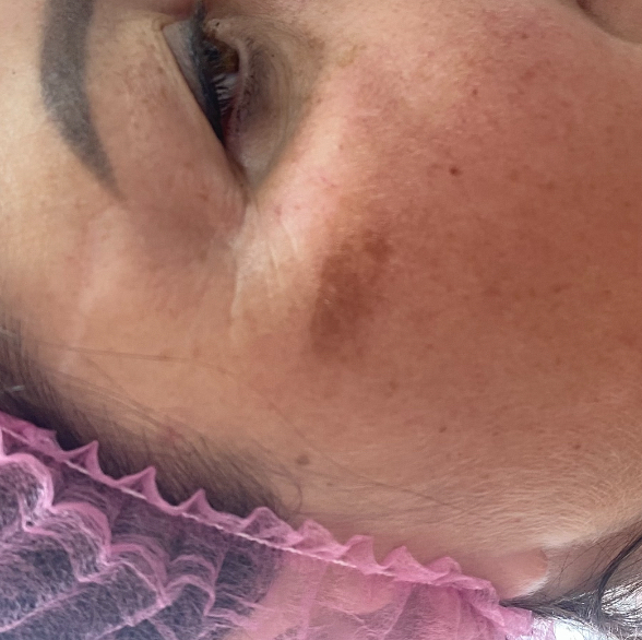 Мезо Скин Брайтениниг