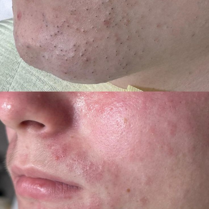 Глубокое очищение+гидропиллинг