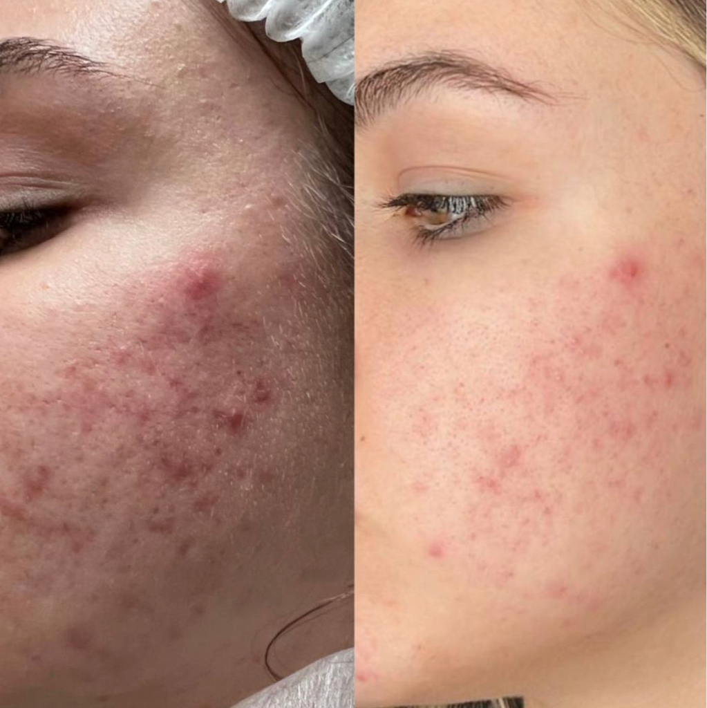 Чистка комбинированная, пилинги Pleyana (Швейцария, Франция)