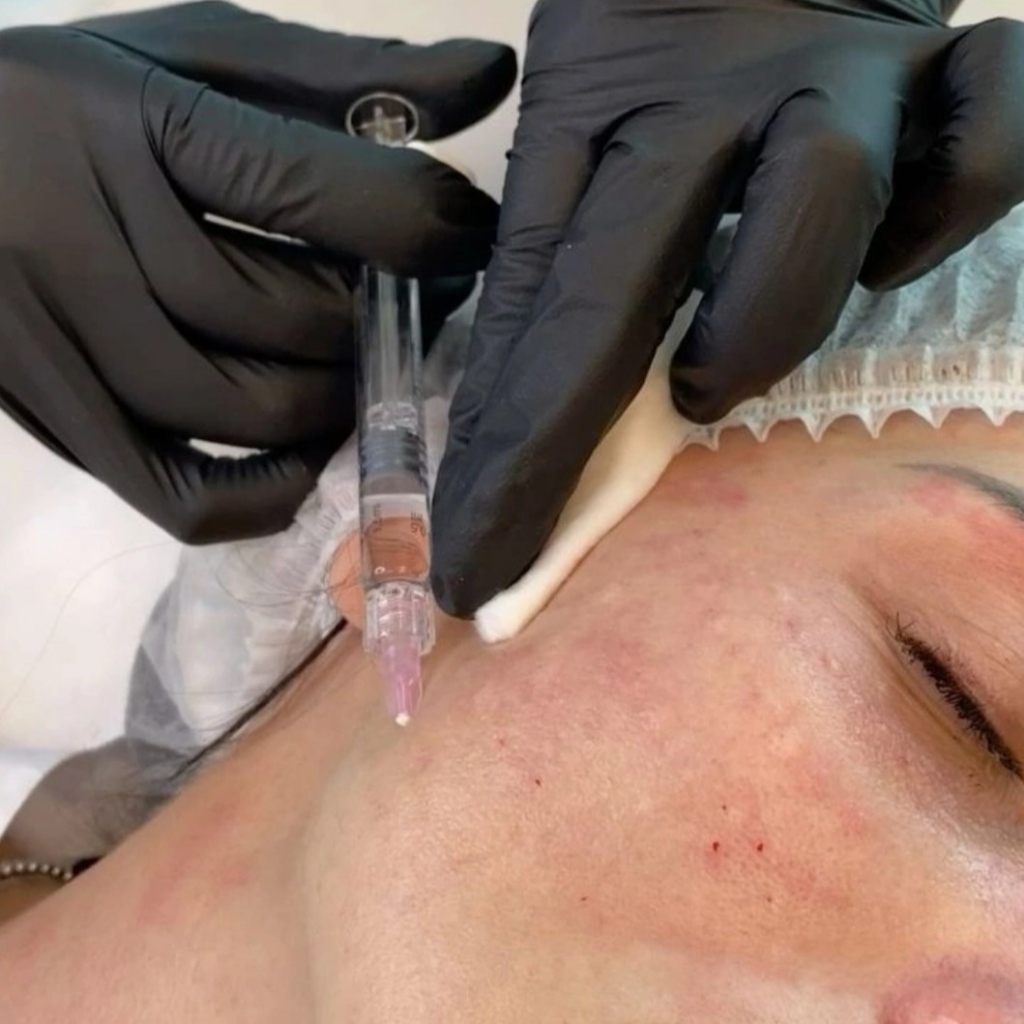 Belotero Hydro  (Белотеро Гидро) 1 мл
биоревитализация (увлажнение кожи)