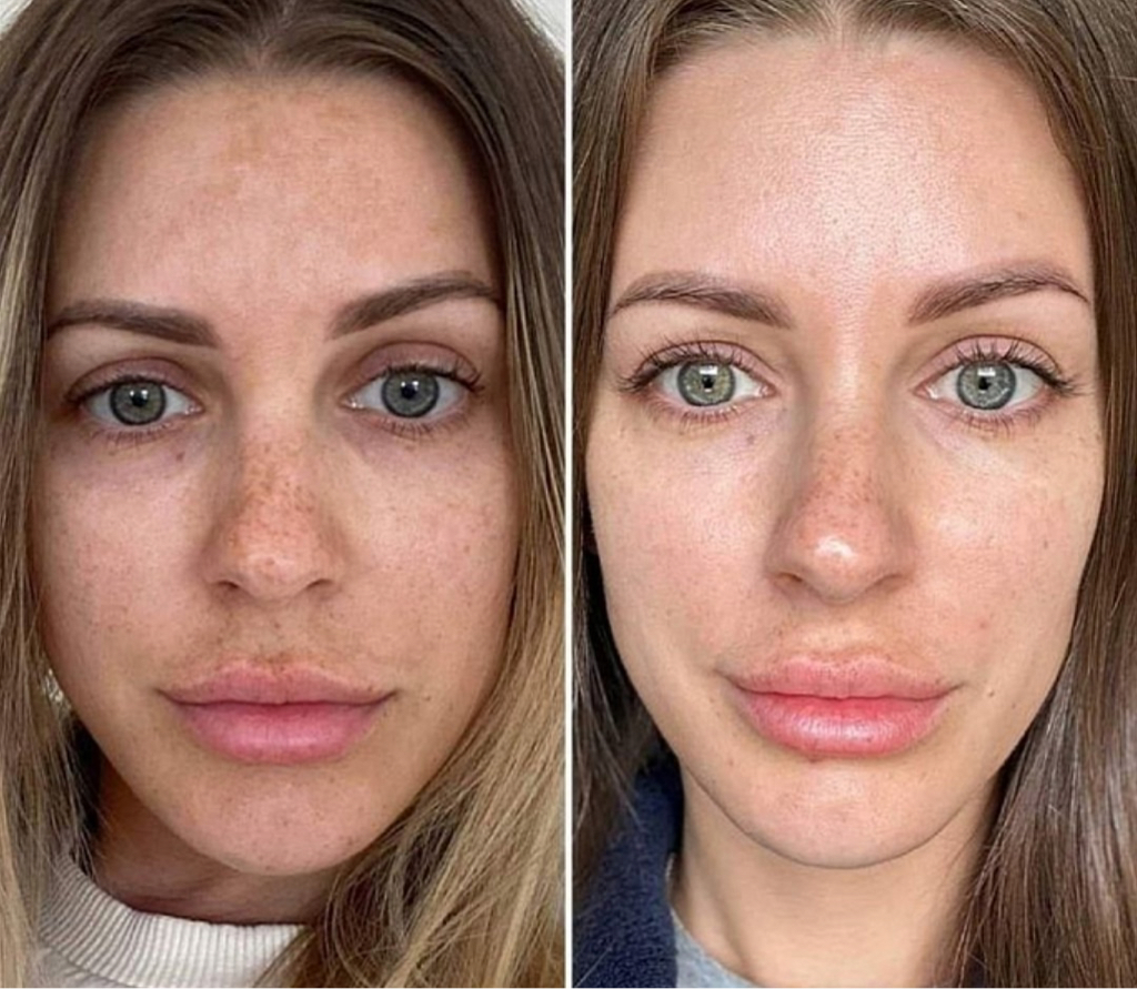 BB GLOW эффект тонального крема   Мезотерапия лица с эффектом тонального крема на 1 год😍👏😍  ✔️Курс 4 процедуры с интервалом 7-10 дней.