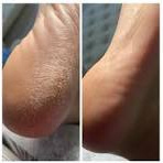 Обработка стоп