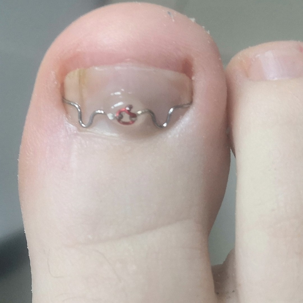 Переустановка  1(одной) Скобы