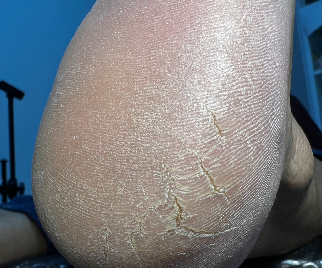 Препаратный педикюр KART (стопы с трещинами) Без декоративного покрытия