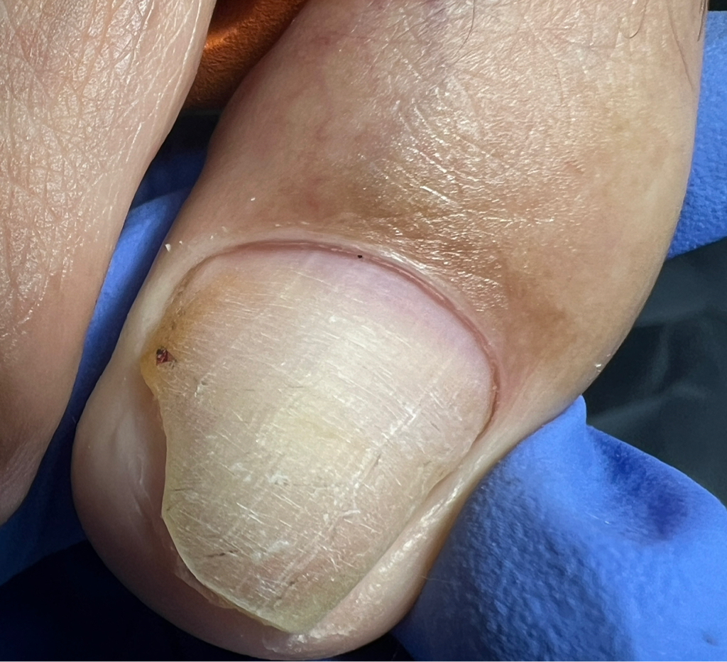 Зачистка онихолизиса