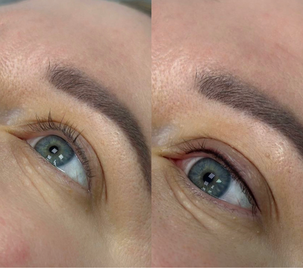 Межресничка