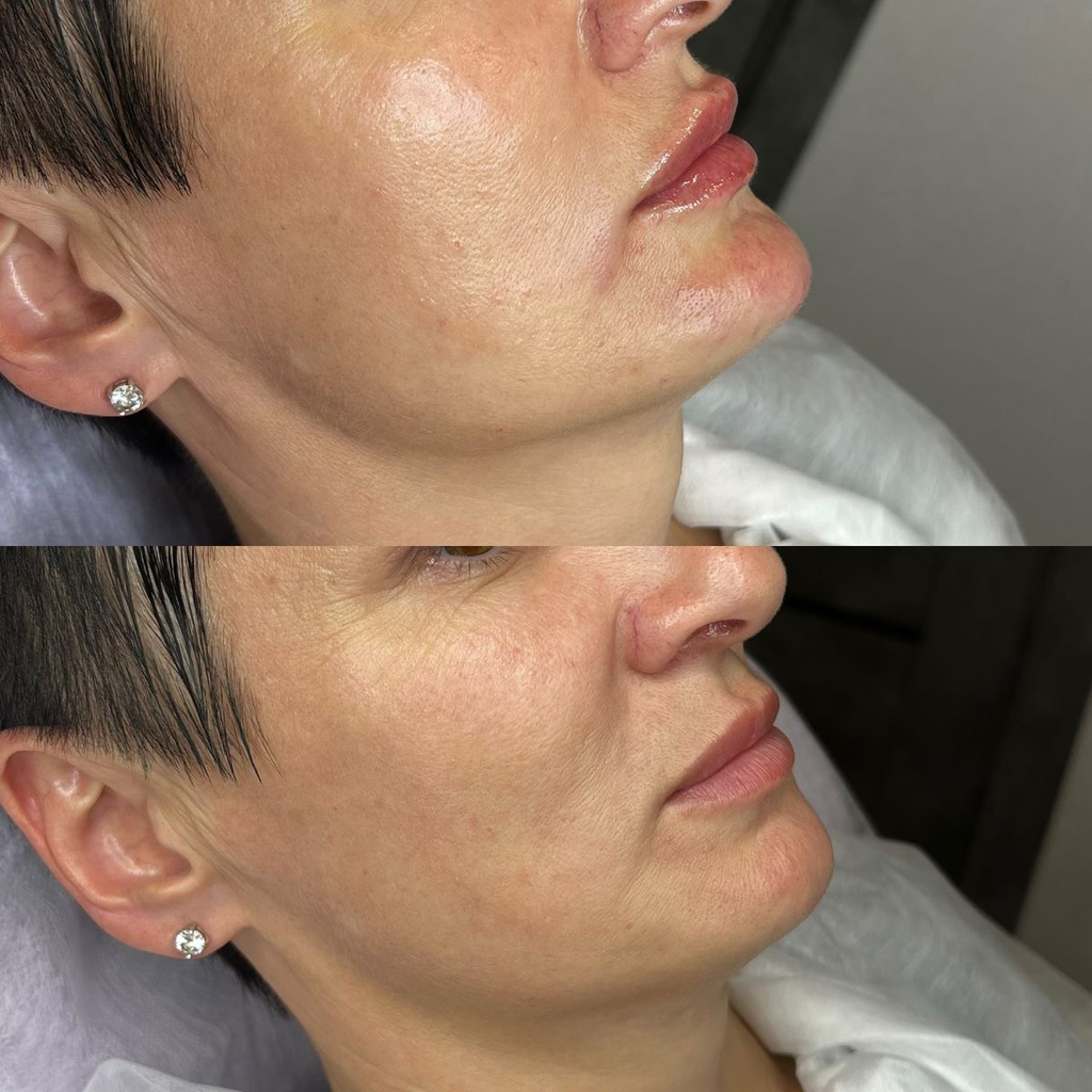 Контурная пластика подбородка Stylage L «1ml»
