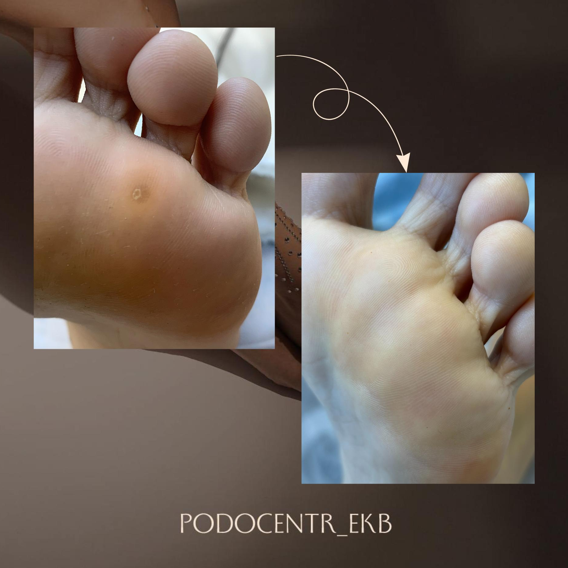 Бородавки. Первичный прием