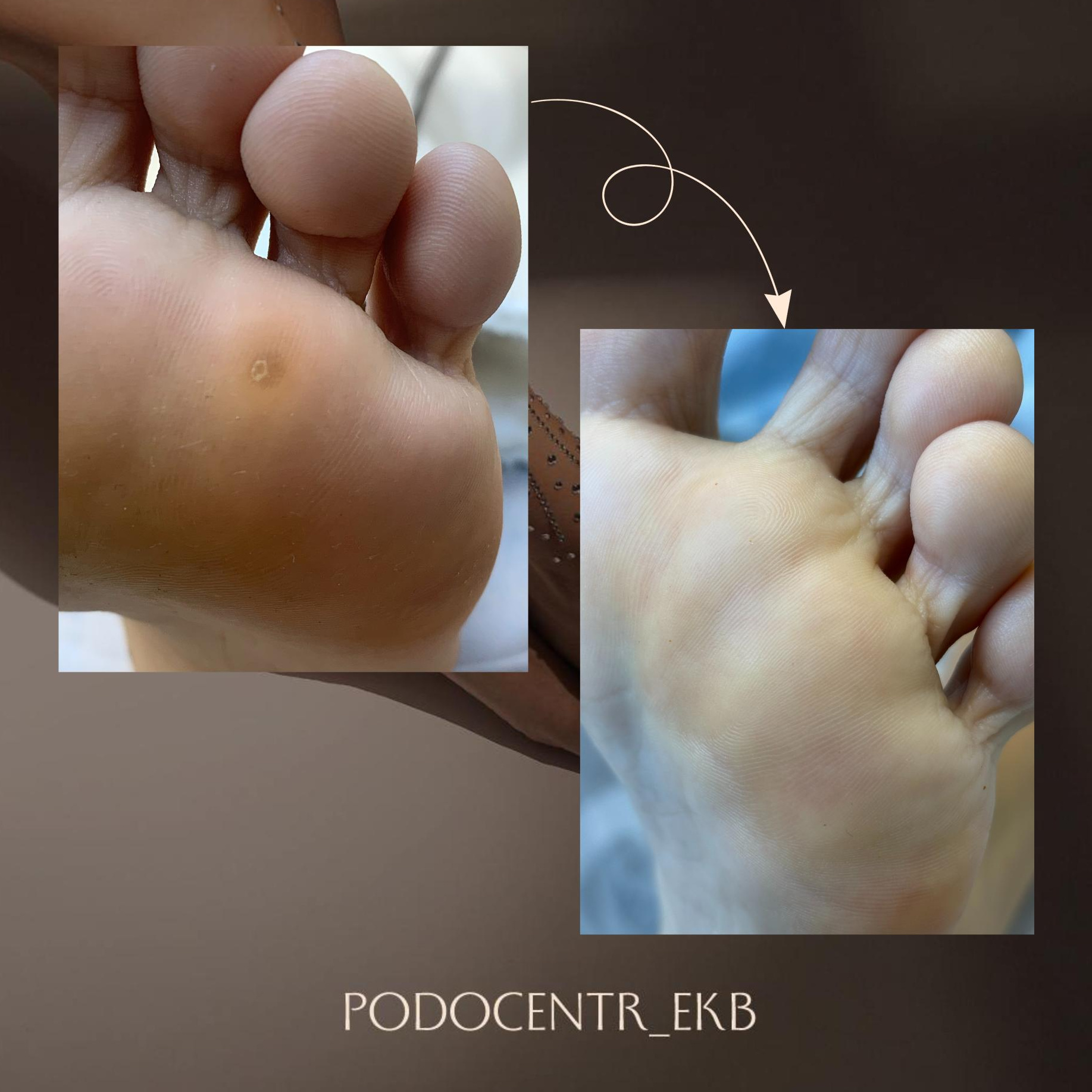 Бородавки. повторный прием