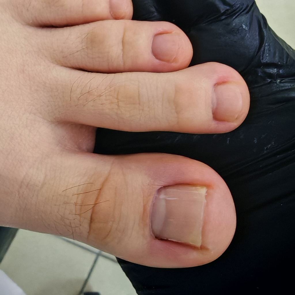 Обработка стоп ног.