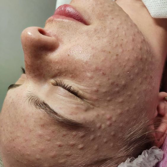 Биоревитализация