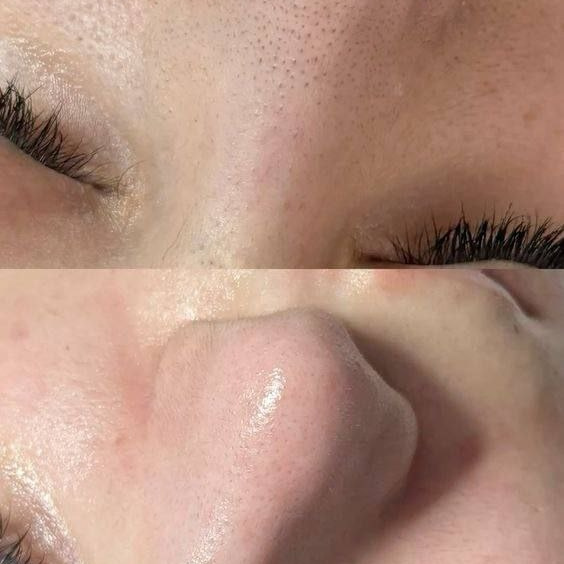 Комплекс комбинированная чистка + пилинг