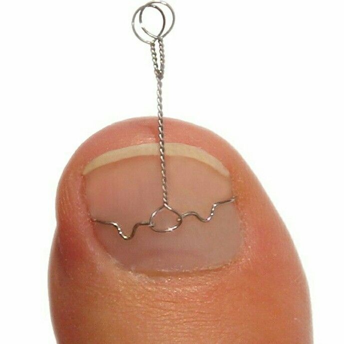 8110 Коррекционная система ЗТО скоба