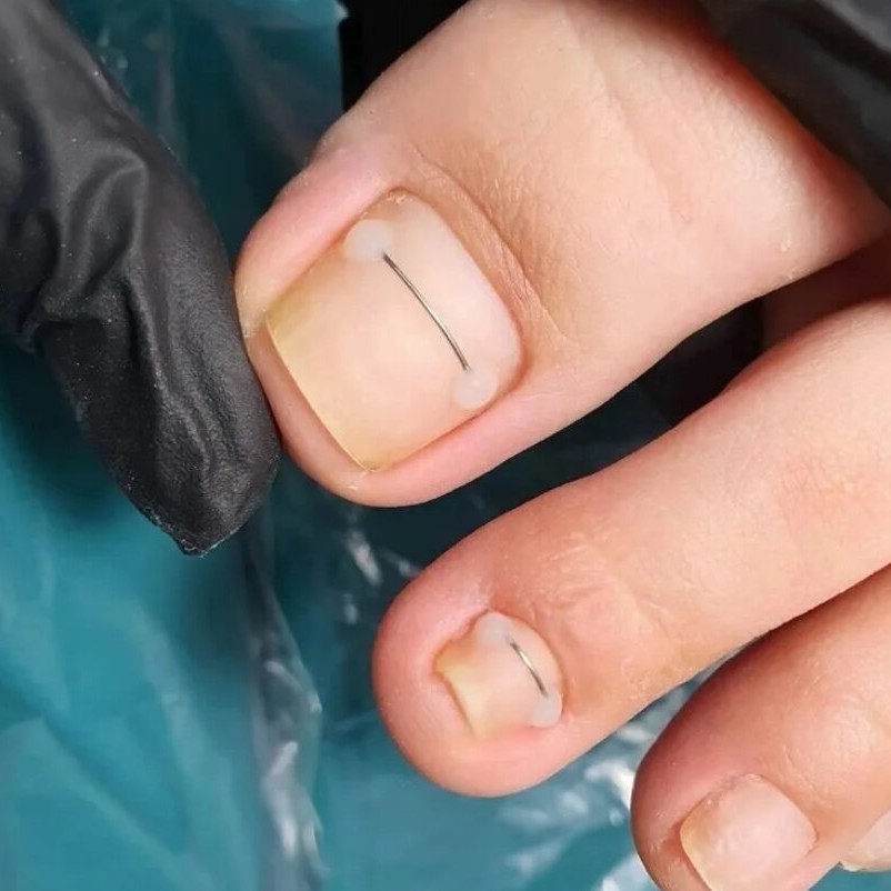 8111 Коррекционая система Титановой нити 1 ед