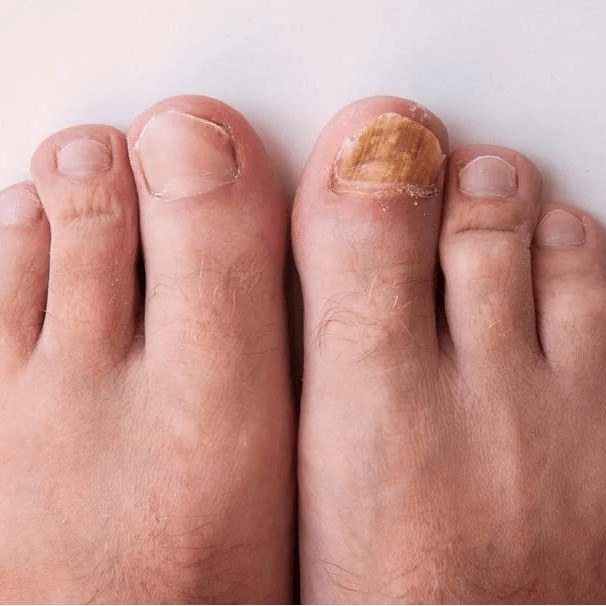 8114 Обработка пораженного утолщенного ногтя 1 ст