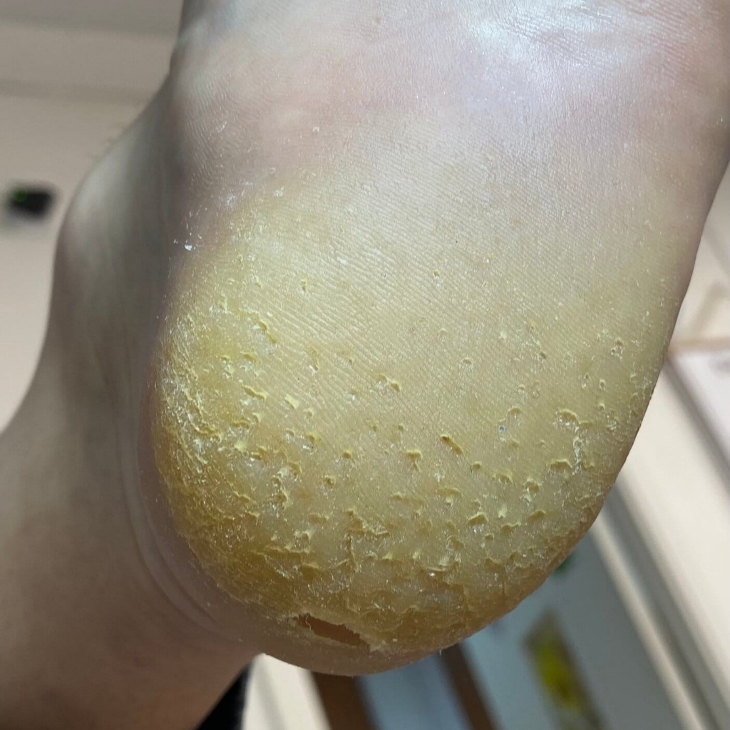 8119 Обработка пятки(трещ,мозоль,натопт,кератоз) 3 ст