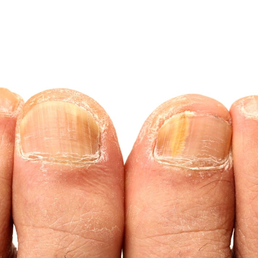 8115 Обработка пораженного утолщенного ногтя 2 ст