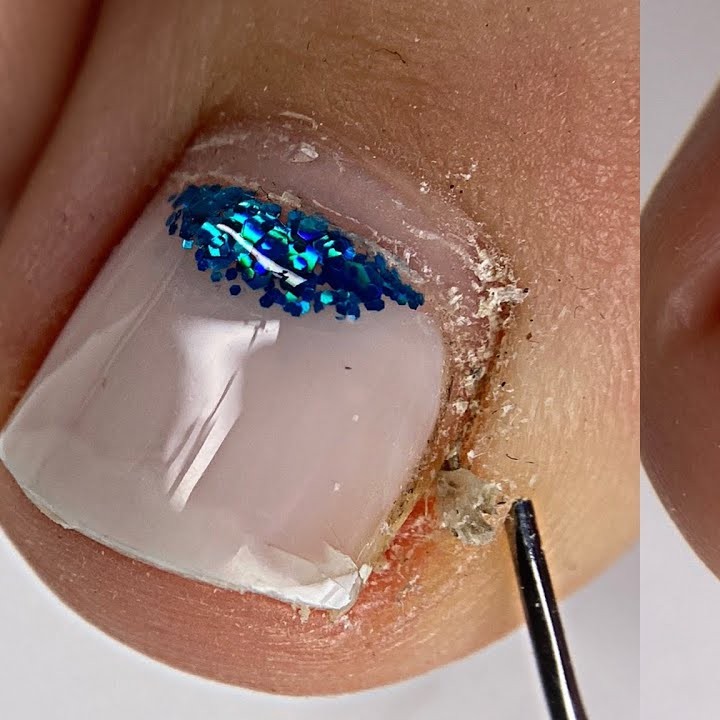 8122 Подногтевая мозоль