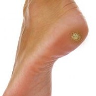 8123 Обработка Бородавки 1 шт.