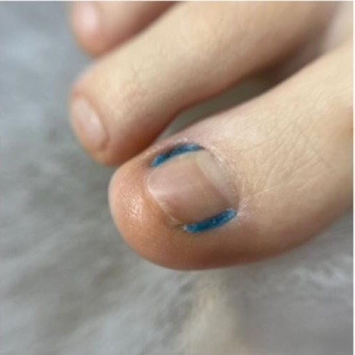 8131 Гелевая тампонада Подол Джест Темпо