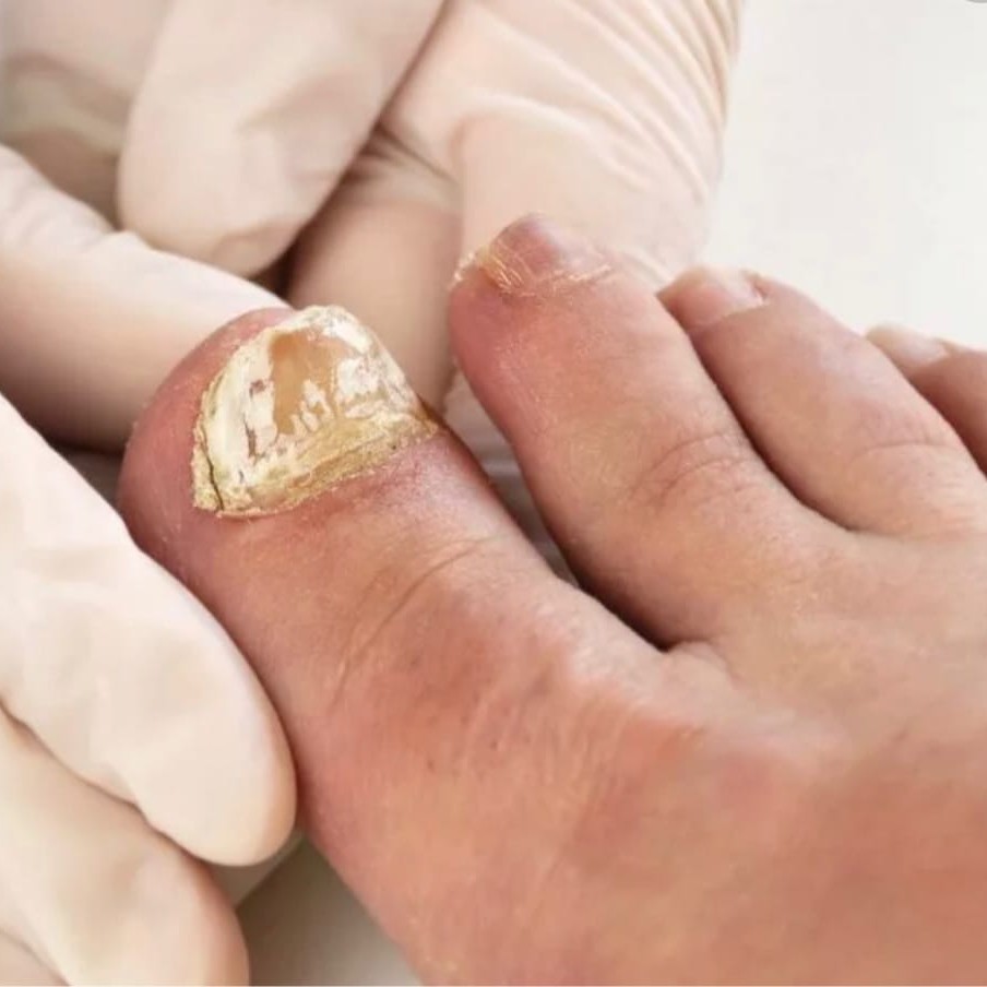 8116 Обработка пораженного утолщенного  ногтя 3 ст