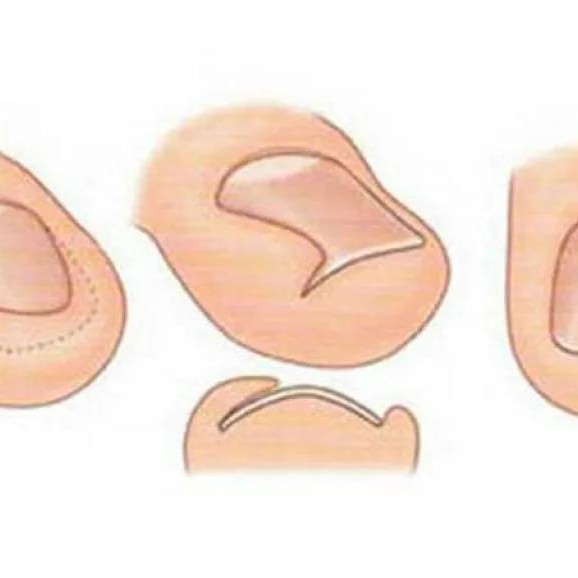 8106 обработка вросшего ногтя 1 степень