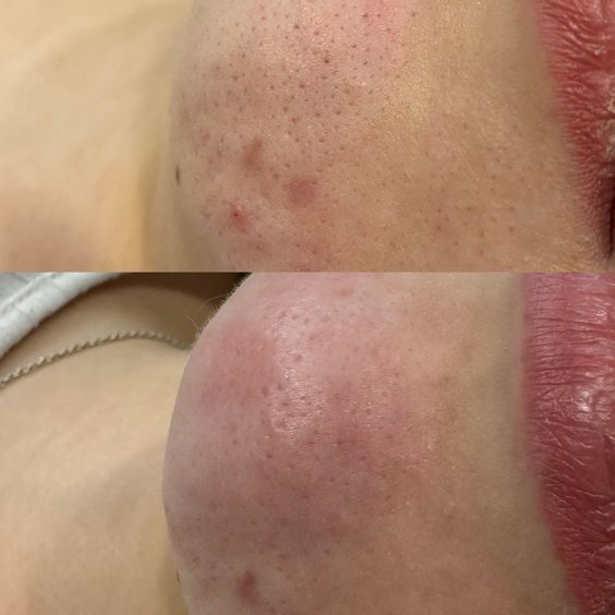 Комбинированная чистка лица/розовый пилинг