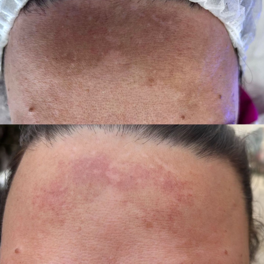 Комбинированная чистка/желтый пилинг